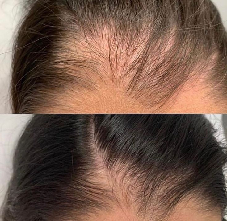 Minoxidil Hair Growth Spray